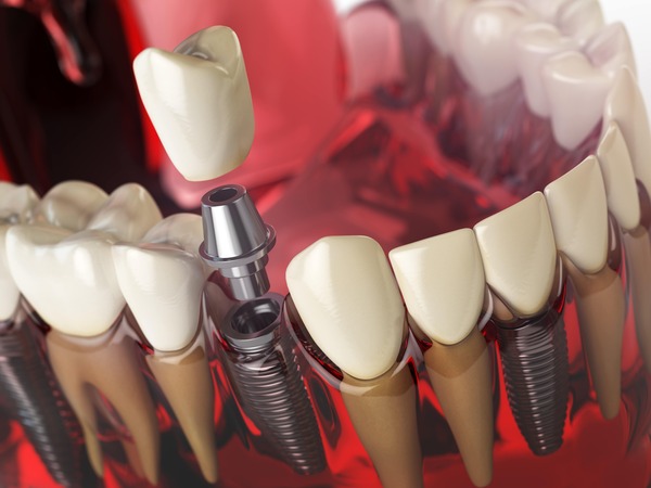 tooth implant in the model human teeth gums